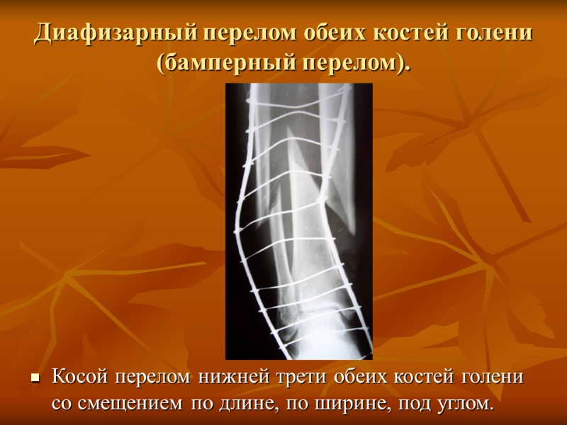 Диафизарный перелом обеих костей голени (бамперный перелом). Косой перелом нижней трети обеих костей голени